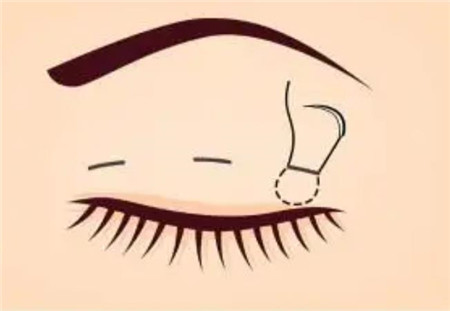 做雙眼皮手術(shù)有哪些后遺癥